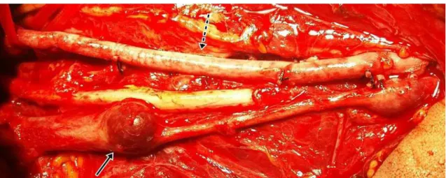 Figure 1. Reconstruction of the left brachial artery with the great saphenous vein reversed (dotted arrow) and aneurysms in the  brachial vein, of which the proximal is more notable (arrow continuous).