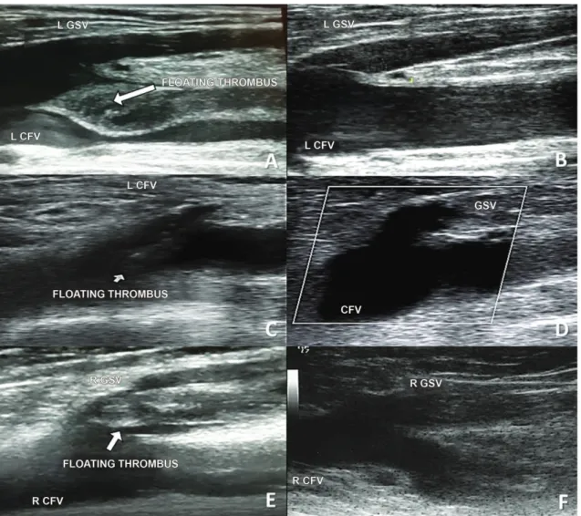 Figure 1. Venous duplex ultrasound from the three cases described. A) Case 1 - Floating thrombus in the left common femoral  vein; B) Case 1 - Recanalization of the left femoral vein; C) Case 2 - Floating thrombus from the saphenofemoral junction to the  l