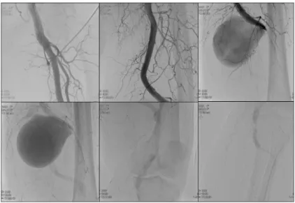 Figure 5. Intraoperative image: dissection of the aneurysm sac.