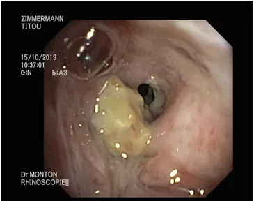 Figura 7: Imagem tirada aquando da rinoscopia de um cão com  aspergilose após 3 semanas (entrada do seio frontal esquerdo) 
