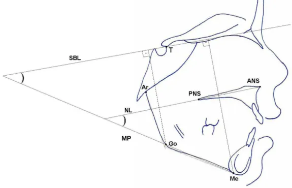 Figure 1 -  Cephalogram illustrating the skeletal landmarks, the angular and  linear  measurements