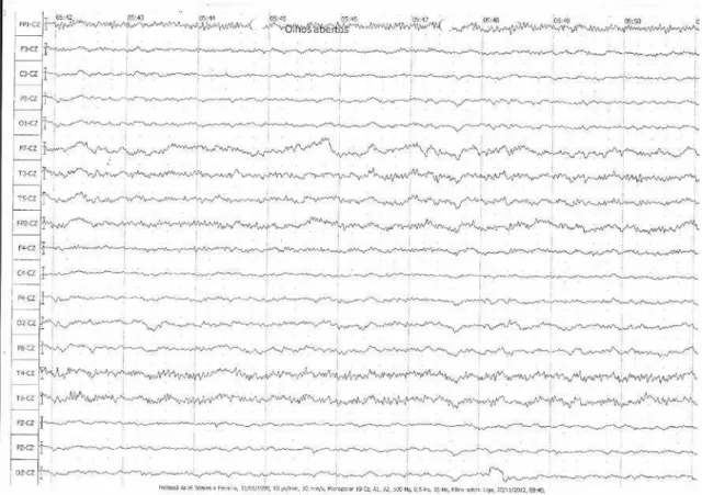 Figure 1. Patient’s EEG tracing shows regular basis beta low amplitude rhythm interspersed by theta waves with moderate  voltage, increasing suspicion of an organic mental disorder worsening the catatonic syndrome.