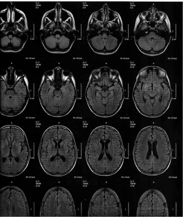 Figure 2. Angio-MRI shows foci of change in the FLAIR sequence on lenticular nucleus, right superior frontal gyrus and left  corpus callosum forceps.