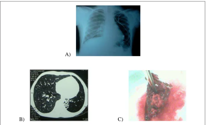 FIGURA 2 - À radiografia de tórax (A) observa-se perda do volume do pulmão esquerdo associada à  hipertransparência  pulmonar  e  rarefação  vascular