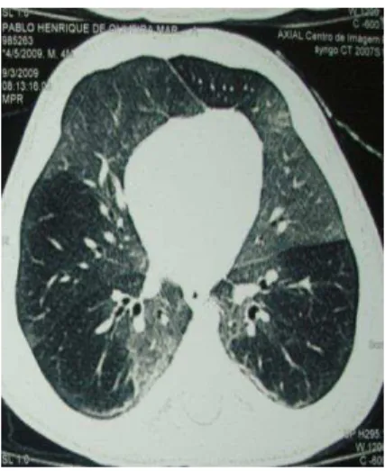 FIGURA 3  – TCAR de paciente de três anos acompanhado no HC/UFMG. Observam-se áreas                  de  atenuação  em  mosaico  em  ambos  os  pulmões  e  bronquiectasias,  indicando  alterações  já 
