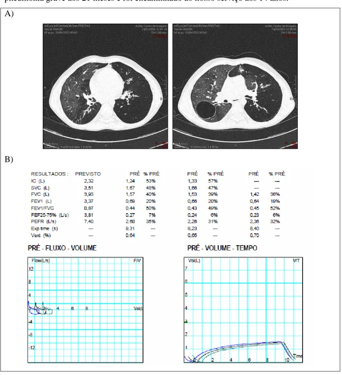 FIGURA 4  – À TCAR (A) observam-se bronquiectasias cilíndricas e varicosas em ambos os pulmões