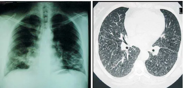 Figure 1. Chest X-ray (left) showing bands of opacity in the lower portions of the lungs
