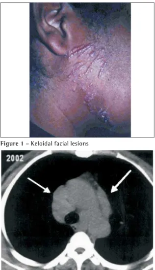 Figure 1 – Keloidal facial lesions