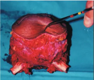 Figure  1    Computed  tomography  of  the  chest  showing the  tumor  at  the  level  of  the  sternal  notch
