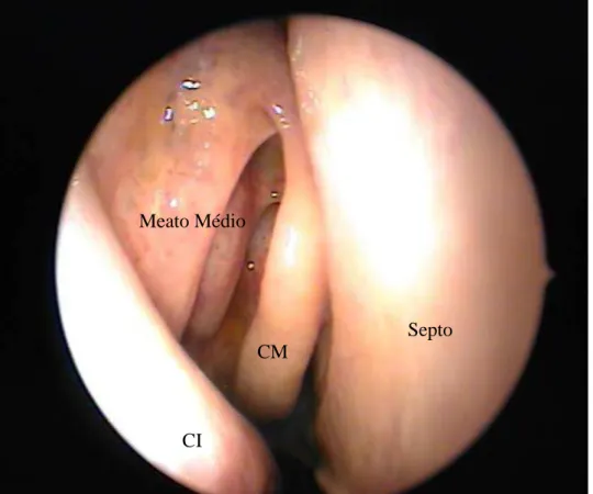 Figura 7. Cavidade nasal direita (CM: corneto médio / CI: corneto inferior). 