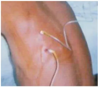 Figure 1. Diagnostic thoracocentesis producing purulent  pleural fluid 