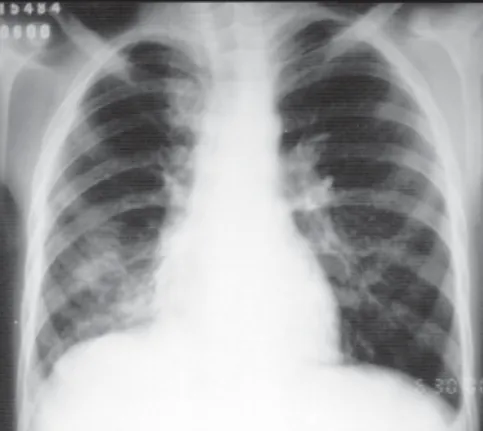 Figure 3A. Chest X-ray in profile with air-fluid level in the  right lower lobe (arrow) 