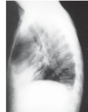 Figure 4A. Chest X-ray in profile showing  loculated effusion with air-fluid level 