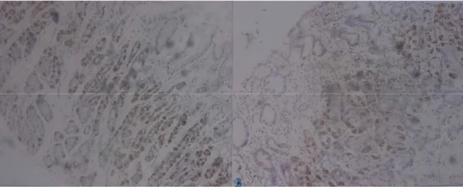 FIGURA 3.  Células parietais da mucosa gástrica oxíntica, A - sem atrofia, B - com  atrofia, pela imunohistoquímica, 50X
