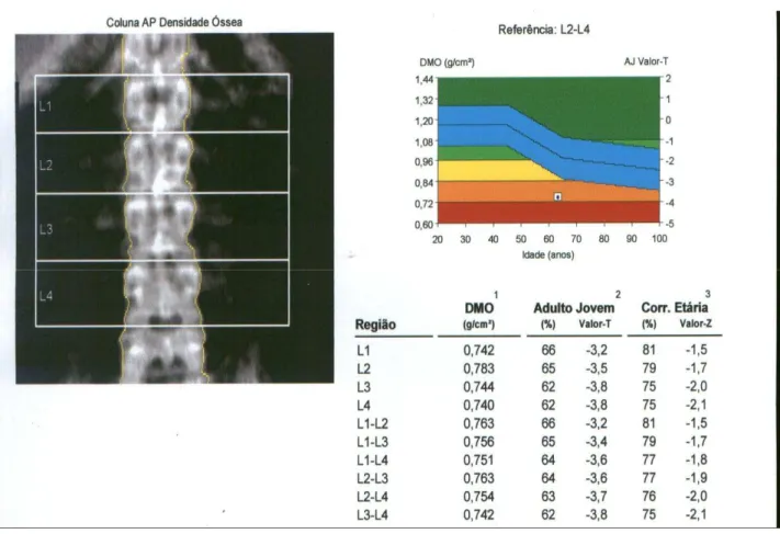 FIGURA 5.  Densitometria  óssea  evidenciando  osteoporose  em  coluna  lombar  (T- (T-score  L1-L4 = - 3,6)