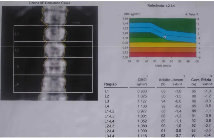 FIGURA 6.  Densitometria óssea evidenciando densidade mineral óssea normal em  coluna lombar (T-score  L2-L4 = - 0,9)