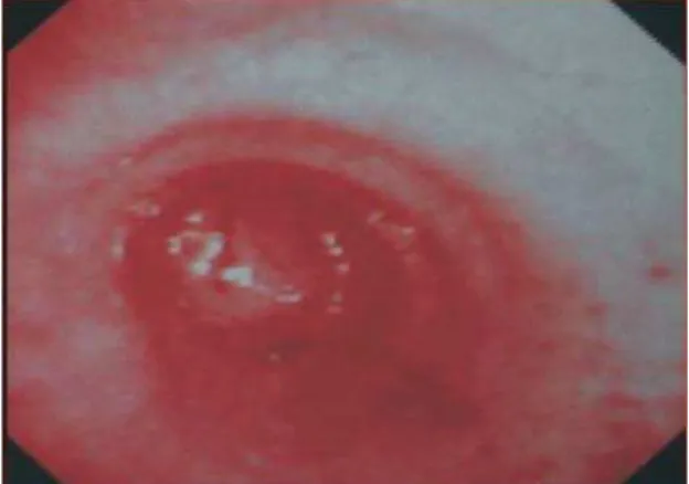 Figure 1 - High-resolution computed tomography scan revealing the presence of an endobronchial lesion in the left main bronchus