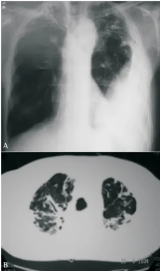Figure 1 - a) Chest X-ray revealing left-sided pleural effusi- effusi-on accompanied by bands in both upper lobes of the lungs b) Computed tomography scan of the chest revealing  bron-chiectasis and nodules.