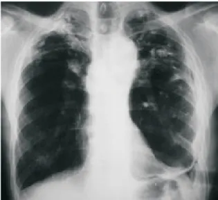 Figure 2 - Chest X-ray revealing pulmonary expansion after drainage and tube thoracostomy with the prosthesis inserted into the left costophrenic angle.