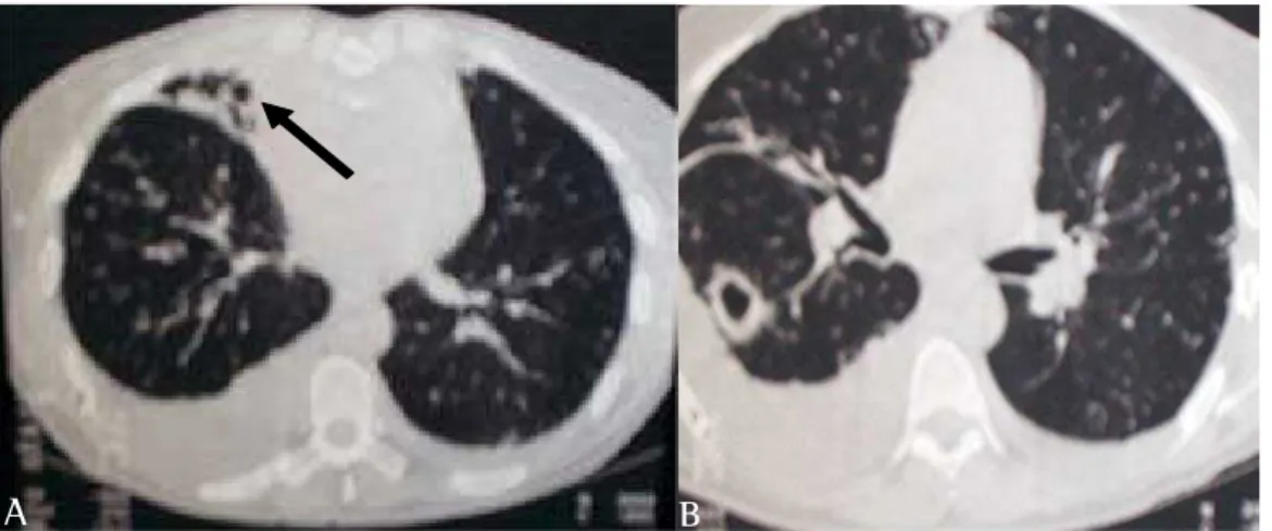 Figure 3 - A) Images suggestive of cysts in the middle lobe with signs of bronchiectasis-related retraction (arrow) and bilateral pleural effusion, more pronounced on the right; B) Thick wall cavitation in the lower right lobe and bilateral pleural effusio