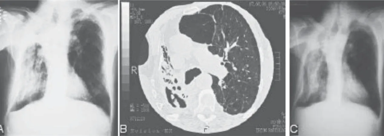 Figure 1 -  A) Chest X-ray of a mass within the cavity in the upper lobe of the right lung; C) Control examination carried out two years after treatment with itraconazole, revealing the elimination of the mass within the cavity; B) Computed tomography (CT)