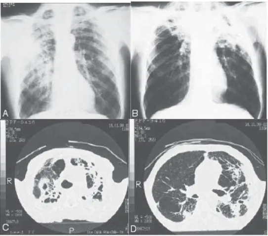 Figure 2 - A) Chest X-ray showing areas of consolidation in the axillary subsegments of the right lung