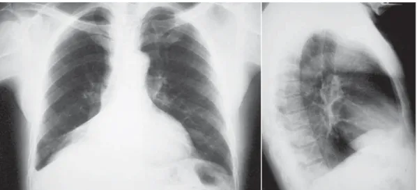 Figure 1 - Anteroposterior and lateral chest X-ray: atelectasis of the right lower lobe, characterized by a t-shaped opacity obliterating the right border of the heart, with flattening of the right hilum and elevated right diaphragmatic dome
