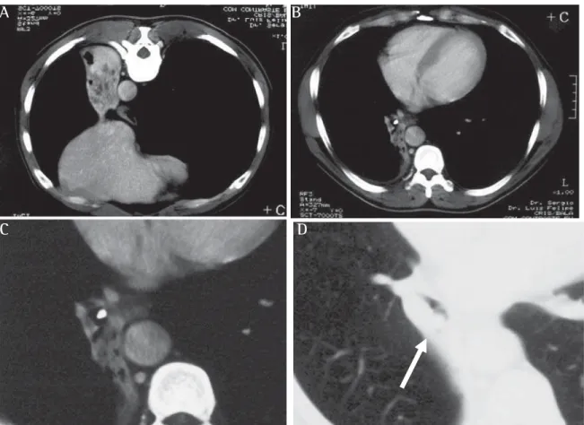 Figure 2 - Computed tomography scan of the chest: signs of reduced volume with bronchiectasis in the right lung (A and B) due to a totally calcified nodule the in the lumen of the right lower lobe bronchus (C and D)