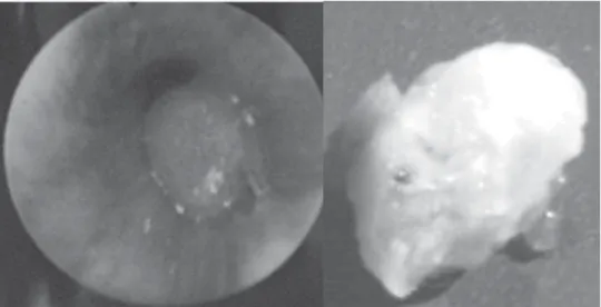 Figure 3 - Bronchoscopic view: A) Lesion totally obstructing the lumen of the right lower lobe bronchus