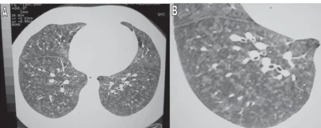 Figure 2 - A and B) High-resolution computed tomography scan showing small, ill-defined bilateral nodular opacities and a diffuse ground-glass pattern