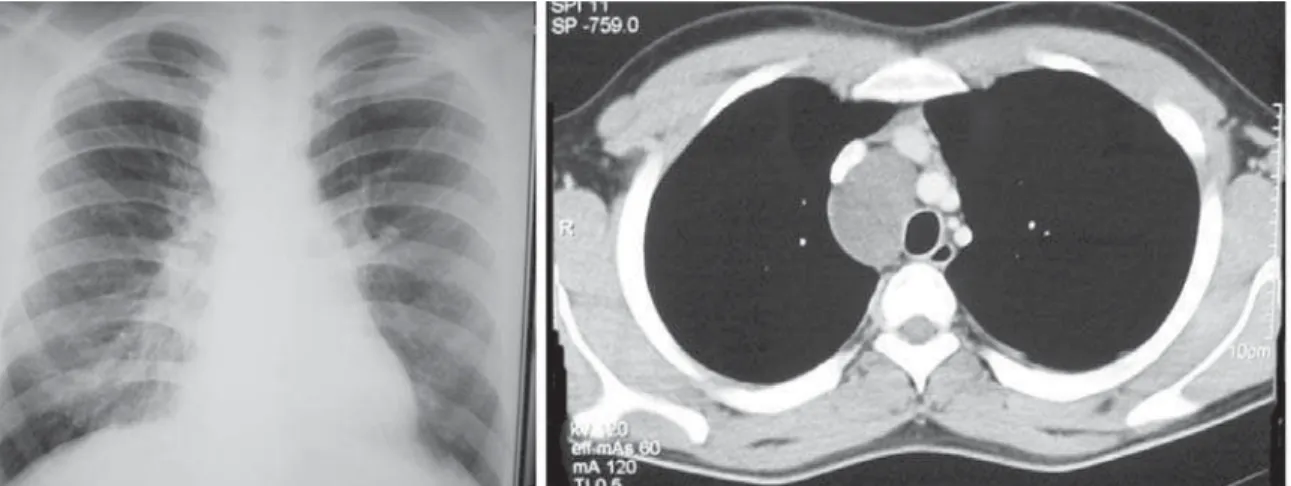 Figure 1 - Anteroposterior chest X-ray and computed tomography scan of the chest showing right-sided paratracheal cystic lesion