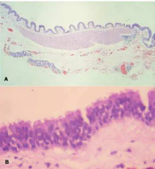 Figure 3 - Histopathological image of the cystic lesion (Hematoxylin and Eosin, magnification - A: x40 / B: x400).
