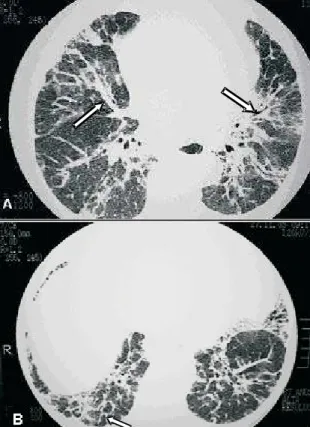 Figure 8. Reticular opacities. Pulmonary sarcoidosis with septal thickening of the upper lobes, forming polygonal arches (arrows), simulating lymphangitic carcinomatosis