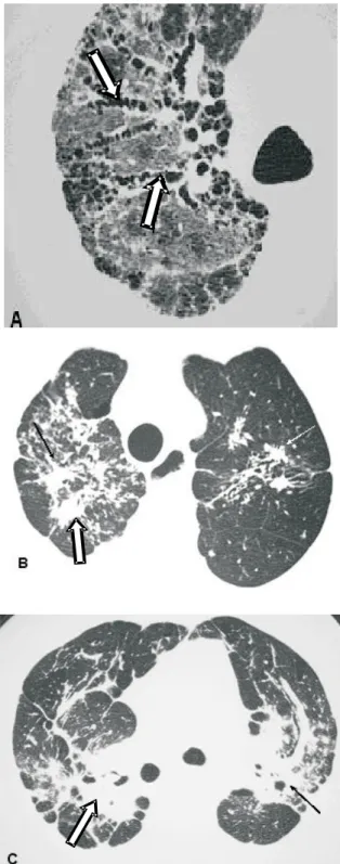 Figure 12. Fibrosis. Posterior subpleural honeycombing, predominantly in the lower lobes (arrows)