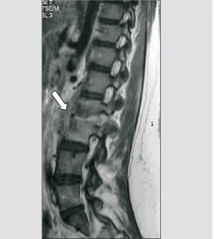 Figure 2. Magnetic resonance imaging (MRI) showing fusion of L1-L2 vertebral bodies