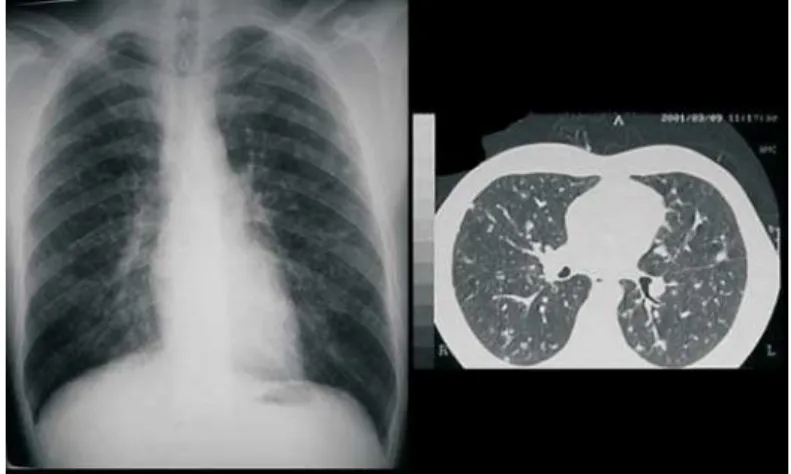 Figure 1. Chest X-ray showing multiple focal nodules distributed throughout both lungs, high-resolution computed tomography confirming the presence of multiple small nodules, without cavitations or cysts