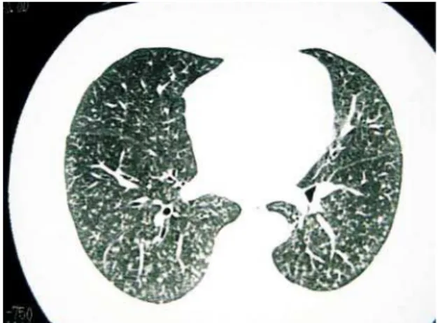Figure 1. Computed tomography scan of the head, presenting recurrent meningioma in the left temporal lobe