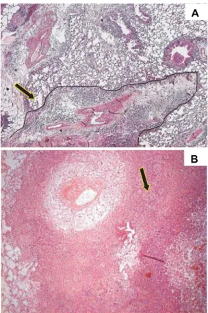 Figure 1 – A. Histological image of a wedge-shaped pulmonary infarction in the lung periphery