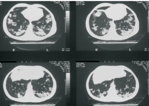 Figure 2 – Bilateral diffuse pulmonary infiltrate with granular areas and some central nodular opacities