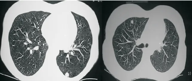 Figure 1 – Computed tomography showing pulmonary nodules located in the lower left and upper right lobes