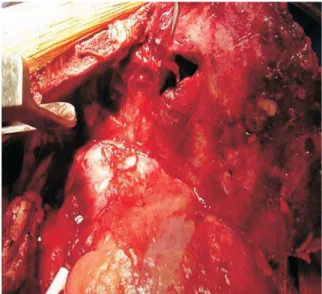 Figure 3 – Paraganglioma located at the level of the aortic arch