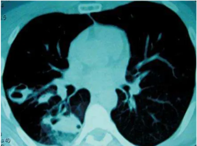 Figure 3 – Third computed tomography scan, performed on day 15 after the trauma, showing significantly reduced infiltrate in relation to the previous exam.