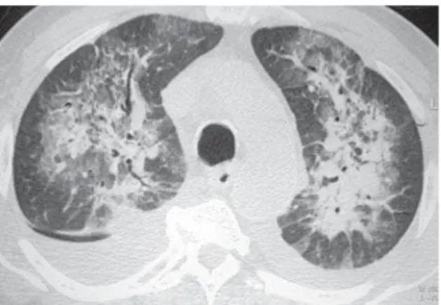 Figure 1 - High-resolution computed tomography scans, showing slices acquired at the lung bases, using a pulmonary window, in a patient with congestive heart failure presenting ground-glass opacities and smooth interlobular septa thickening, a mosaic patte