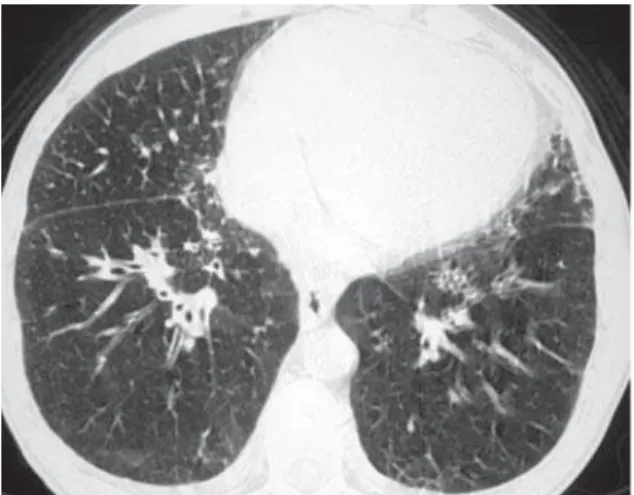 Figure 4 - High-resolution computed tomography scans, showing slices acquired at the level of the lower third of the lungs, using a pulmonary window, revealing peribronchovascular interstitial thickening and discrete thickening of the interlobular septa, m