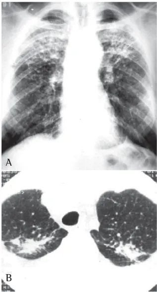Figure 1 - A) Typical case of accelerated silicosis in a 53- 53-year old patient, a sandblaster at a dockyard, with an  18-year exposure to silica