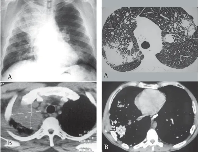 Figure 2 - A) Atypical case of accelerated silicosis case in a 45-year old patient, a blacksmith with a 10-year exposure to silica, complaining of chest pain in the right hemithorax, coughing with hemoptysis and weight loss