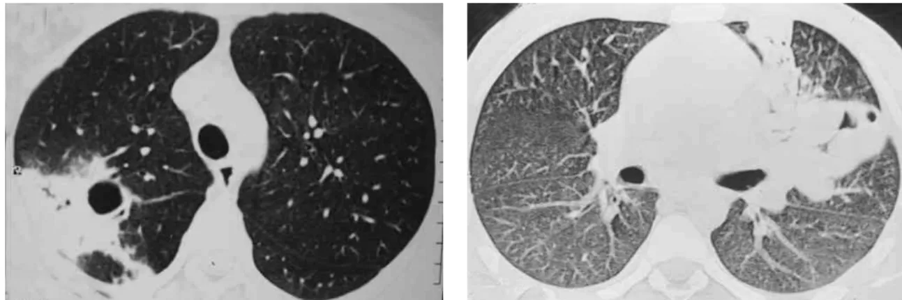 Figure 2 - High-resolution computed tomography. Cavitated pulmonary consolidation, with air bronchogram, in the upper right lobe