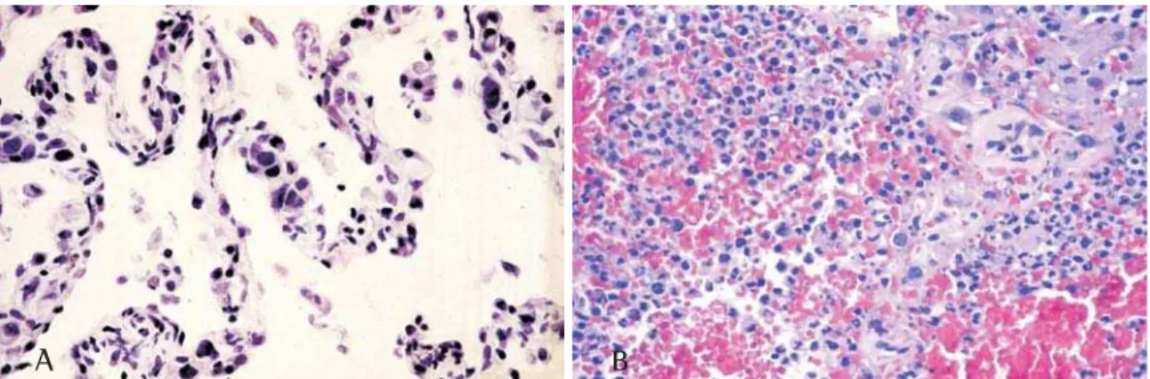 Figure 2 - Diffuse alveolar damage induced by herpes simples vírus. A) Nuclear cytopathic effect in type II pneumocytes (arrows) (H &amp; E, X400)