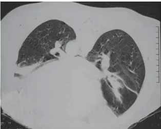 Figure 1 - Computed tomography scan of the chest in the ventral decubitus position. Note the homogeneous opacities in the lung bases, which are consistent with areas of pulmonary collapse, probably due to hypoventilation
