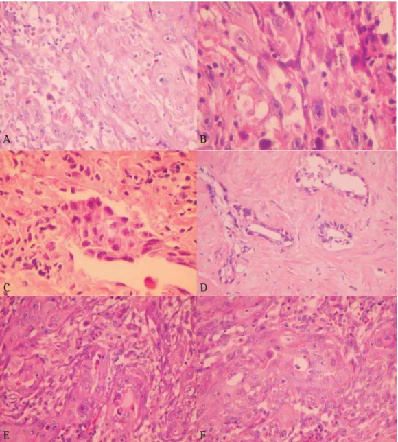Figura 2 - (A a F) O padrão histológico de mesotelioma maligno mostrado nas seções de A a F exige o diagnóstico diferencial entre o subtipo bifásico e o adenocarcinoma com estroma desmoplásico